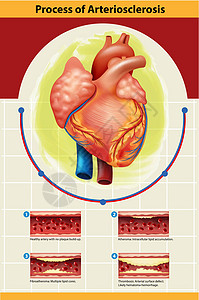 动脉硬化过程海报艺术器官静脉科学图表医疗疾病绘画插图生物背景图片