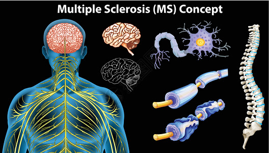干细胞显示多发性硬化症概念的图表卫生器官解剖学血管科学静脉绘画保健神经系统核子插画