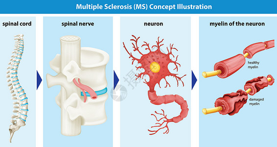 脊神经显示多发性硬化症概念的图表神经解剖学健康生物疾病艺术夹子器官硬化癌症设计图片