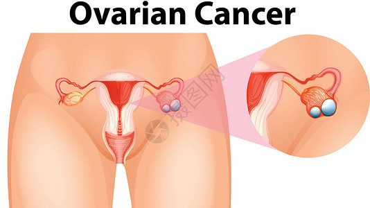 显示卵巢癌的图表插画
