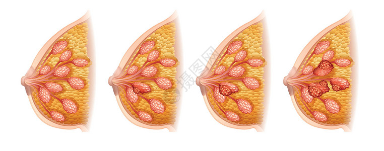 X光人体显示人类乳腺癌的图表插画