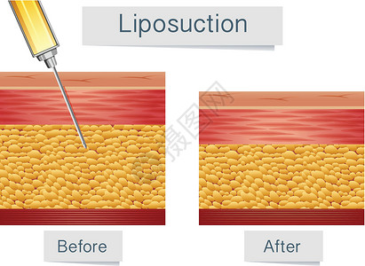 整形外科吸脂医学治疗与比较设计图片