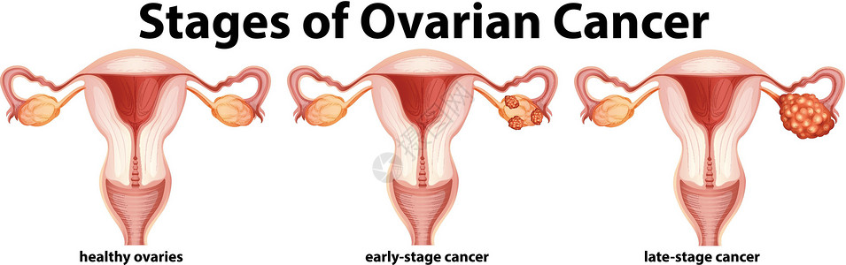 显示卵巢癌分期的图表插画