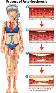 动脉硬化医学插图的过程背景图片