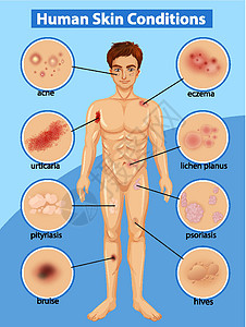 皮肤湿疹显示不同人体皮肤状况的图表设计图片