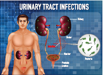尿路感染信息海报微生物学科学绘画艺术病理教育夹子生理解剖学膀胱设计图片