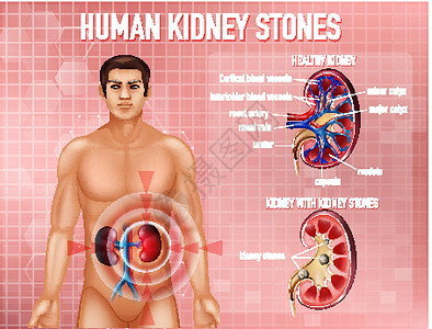 肌肉素材图肾结石资料图男人科学药品肾脏身体剪贴微生物学意义生物学医疗设计图片