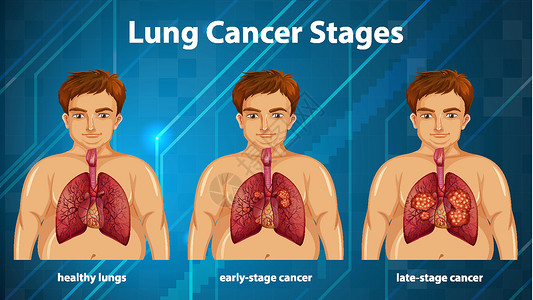 肺癌分期的资料图教育生理学习药品微生物学图表病理绘画解剖学器官背景图片