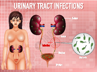 尿路感染的资料图生理微生物学女性刀片生物学海报科学图表卡通片疾病设计图片
