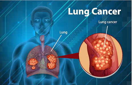 肺癌的资料图微生物学症状卡通片器官生理病理科学意义教育插图背景图片