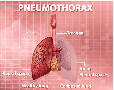 气胸器官绘画高清图片