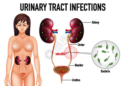尿路感染信息海报夹子科学图表生物学膀胱微生物学教育意义绘画插图设计图片