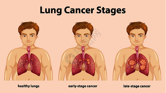 肺癌分期的资料图学习男人卡通片症状男性科学肥胖教育器官病理背景图片