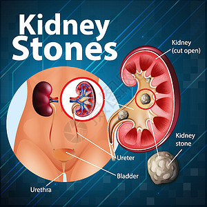 肾结石资料图信息肾脏身体药品解剖学绘画剪贴微生物学意义卡通片设计图片