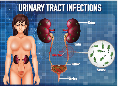 尿路感染信息海报微生物学病理卡通片生理夹子插图生物学艺术解剖学教育设计图片
