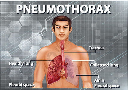 生理人体解剖学气胸图设计图片