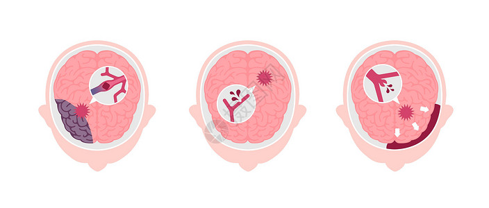 人类脑中中风病媒说明类型中风大脑情况压力科学脑梗塞高血压船只静脉警告背景图片