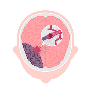 人脑中风的类型矢量图脑梗塞大脑静脉心血管信息船只警告脑血管解剖学攻击压力背景图片