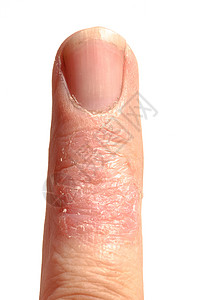 皮肤过敏性皮质拉什埃切马指伤口过敏疾病表皮疼痛手指卫生状况皮肤科皮炎关心高清图片素材