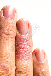 皮肤过敏性皮质拉什埃切马指表皮皮疹剥皮卫生湿疹保健过敏手指伤口疼痛疾病高清图片素材