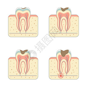 牙周疾病蛀牙病牙疼牙周解剖学疾病脓肿搪瓷运河牙齿疼痛牙科设计图片