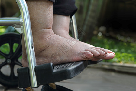 老化测试老年妇女在轮椅上进行高肿脚的体压测试脚肿照顾者女士祖母保健糖尿病药品皮肤女儿点蚀背景