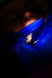 在橡胶大坝 橡胶大坝和牙科镜的隔绝物上用白色合成树脂填牙后 将病人的嘴缝合治疗诊所钻孔口服牙医夹钳乐器喷射考勤镜子背景