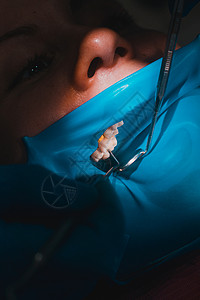 在橡胶大坝 橡胶大坝和牙科镜的隔绝物上用白色合成树脂填牙后 将病人的嘴缝合器械程序框架矫正围堰医生尖端疾病镜子口服背景