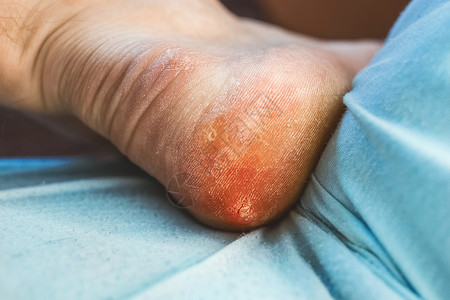 皮肤真菌男人的腿和玉米 关上门来 笑声疾病疼痛痛苦卫生化妆品皮炎医生诊所脚跟组织背景