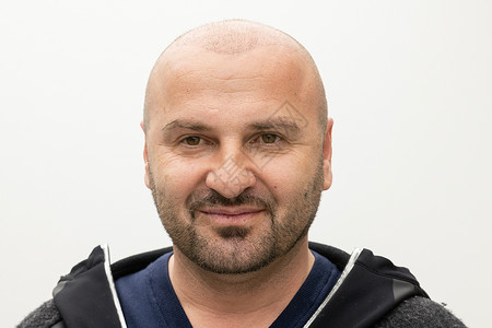 男性在理发后进行植发治疗药品外科脱发秃顶医院诊所移植皮肤秃头成人背景图片