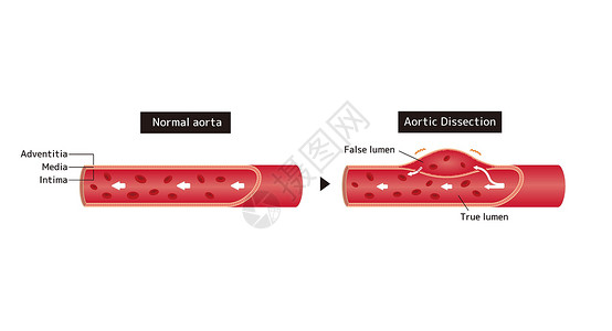 血管造影正常动脉和张动脉解剖的比较说明设计图片