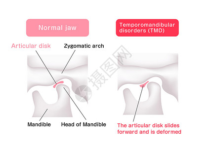 颞下颌关节比较动脉磁盘形状正常下巴和坦波罗曼二脑紊乱的说明疾病渲染插图骨骼关节盘外科骨头矫正牙齿颅骨设计图片