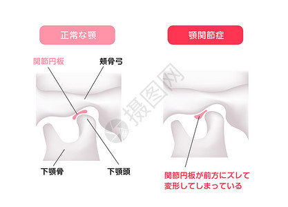 颞下颌关节比较动脉磁盘形状正常下巴和坦波罗曼二脑紊乱的说明颅骨插图关节盘下颌渲染面部身体药品手术骨骼设计图片