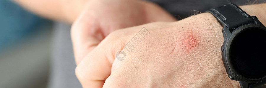 将红斑贴在人手的皮肤上关心高清图片素材