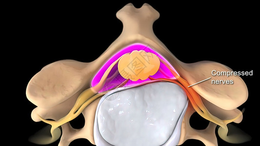 脊柱变形破碎变形的盘片 对神经施压生物学身体颈椎病胸椎外科韧带整脊循环脊柱光盘背景
