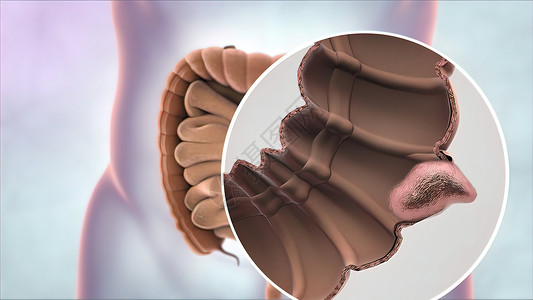 结肠镜消化系统病理高清图片