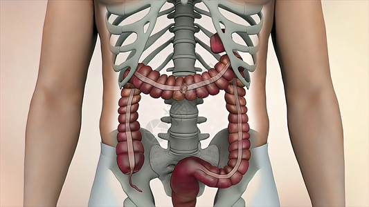 在肠道或肠道癌肿瘤可见的肠透镜检查中 结肠结肠癌男人直肠病理医生消化生物学保健细胞身体疼痛背景