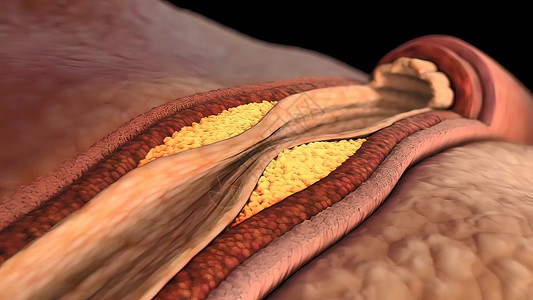 动脉硬化医学与科学高的高清图片