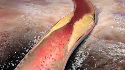 血症将动脉与石碑连在一起肥胖血管攻击科学牌匾医学压力疾病营养动脉粥样硬化背景