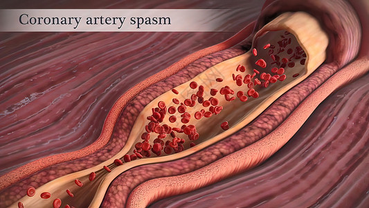 下肢血管冠状动脉抽搐是这些动脉之一的短暂 突然缩小饮食细胞危险动脉粥样硬化心血管营养肥胖血块凝块医学背景