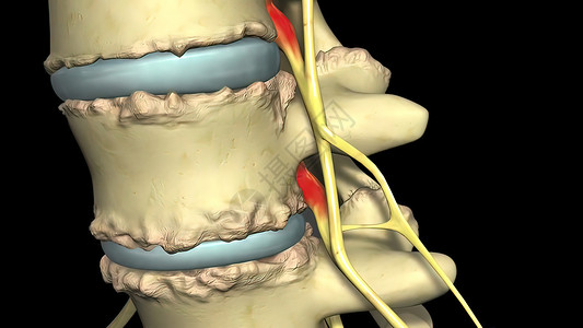 下肢疼痛脊椎萎缩 是神经和脊髓通过 的结骨沟渠收缩过程的结果屏幕帮助病理考试医学诊断脱水外科疼痛脊椎背景