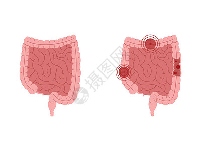 克罗恩回肠溃疡高清图片