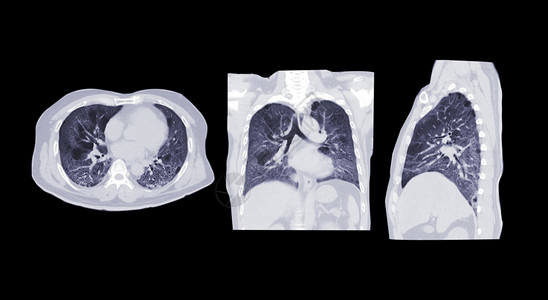 毛玻璃素材收集肺部感染胸腔或肺轴 日冕和外形的CT扫描器 对肺部感染进行盘点-19 地面玻璃不透明性隔绝在黑色背景上背景
