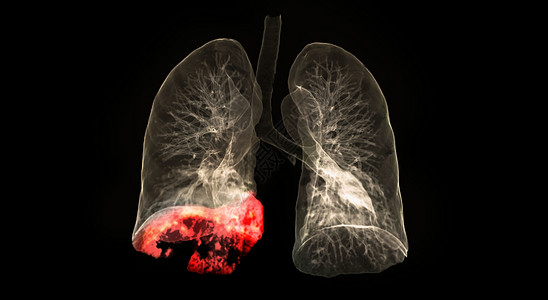 毛玻璃素材胸部或肺部3D成像的CT扫描显示 在与黑背景隔离的右下额叶地区有19个肺部感染背景
