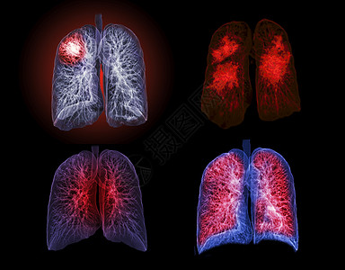 肺结节CT切斯特或肺3D选择性地聚焦于TB 肺结核和共生19的诊断监视器渲染隔膜器官癌症疾病肺炎药品心脏病学医院辐射背景