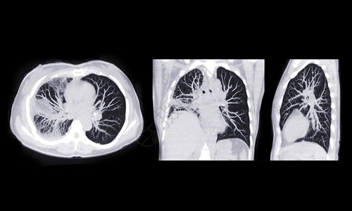 毛玻璃素材CT扫描胸腔或肺轴 日冕和肩部的肺部感染 与地面玻璃不透明共存19度背景