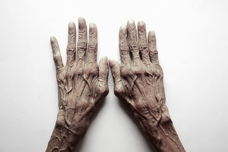 以老年人的手紧贴近老人的手解剖学黑色皮肤疼痛白色老年手指症状拇指展示背景图片
