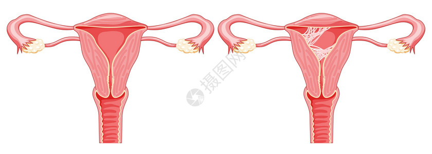 九州通子宫内女性生殖系统疤痕组织粘合症 切开前视线病态和正常器官骨盆生物学输卵管药品癌症插图腹部女性女士插画