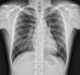 胸前X光图像高血压症状结核病人哮喘疾病动脉疼痛解剖学肺炎背景图片