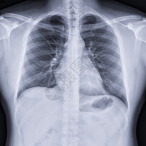胸前X光图像高血压预设解剖学船只心脏病学扫描结核疾病哮喘射线背景图片